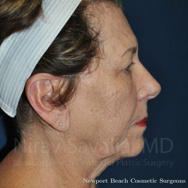 Facelift Before & After Gallery - Patient 1655696 - Before
