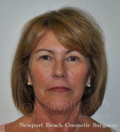 Mommy Makeover Before & After Gallery - Patient 1655694 - After