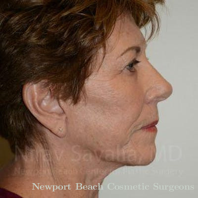 Facelift Before & After Gallery - Patient 1655696 - After