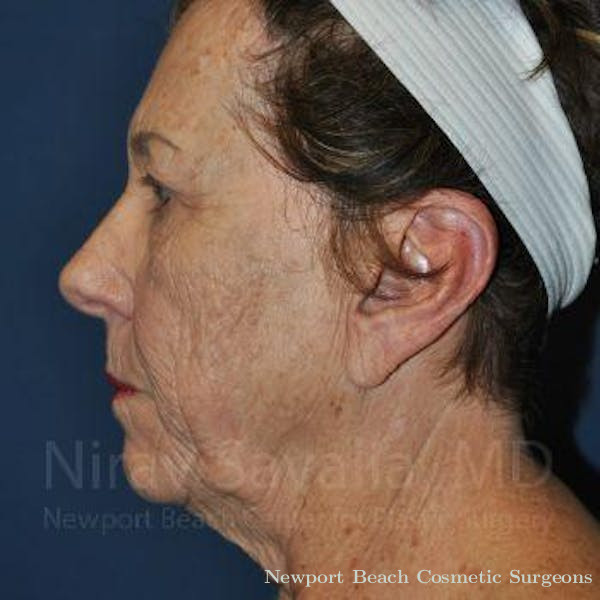 Torn Earlobe Repair Ear Gauge Repair Before & After Gallery - Patient 1655696 - Before