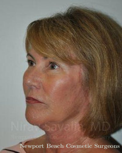 Liposuction Before & After Gallery - Patient 1655694 - After