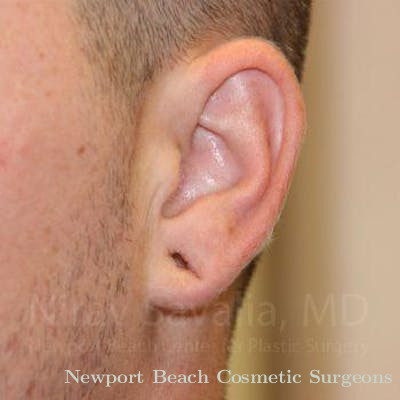 Torn Earlobe Repair Ear Gauge Repair Before & After Gallery - Patient 1655692 - Before