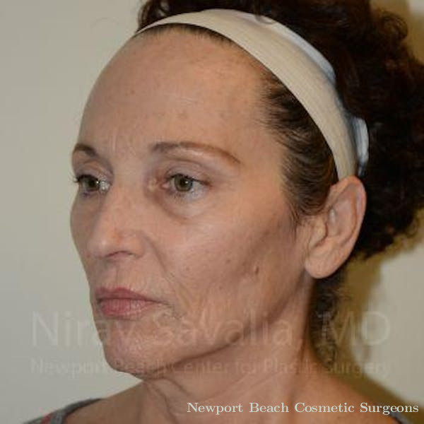 Facelift Before & After Gallery - Patient 1655693 - Before