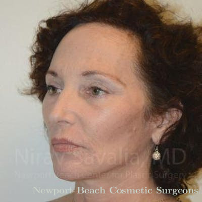 Fat Grafting to Face Before & After Gallery - Patient 1655693 - After