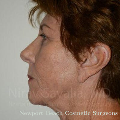 Fat Grafting to Face Before & After Gallery - Patient 1655696 - After