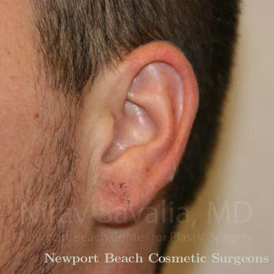 Torn Earlobe Repair Ear Gauge Repair Before & After Gallery - Patient 1655692 - After