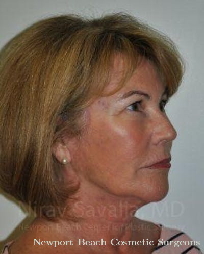 Facelift Before & After Gallery - Patient 1655695 - After