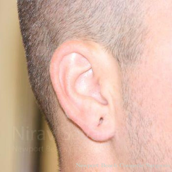 Torn Earlobe Repair Ear Gauge Repair Before & After Gallery - Patient 1655692 - Before