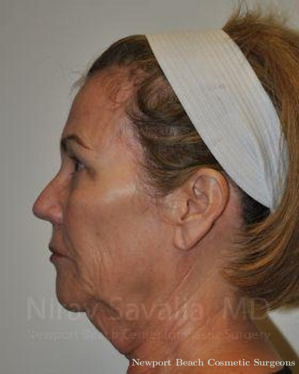 Facelift Before & After Gallery - Patient 1655694 - Before