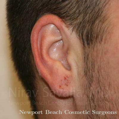 Torn Earlobe Repair Ear Gauge Repair Before & After Gallery - Patient 1655692 - After