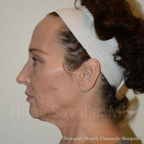 Torn Earlobe Repair Ear Gauge Repair Before & After Gallery - Patient 1655693 - Before