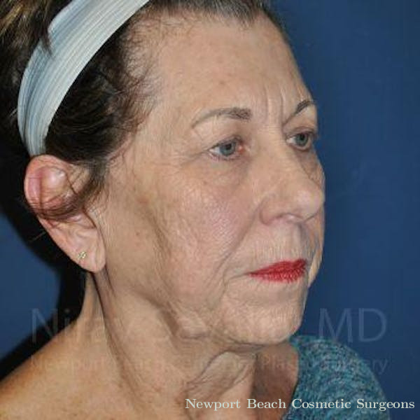Mastectomy Reconstruction Revision Before & After Gallery - Patient 1655696 - Before
