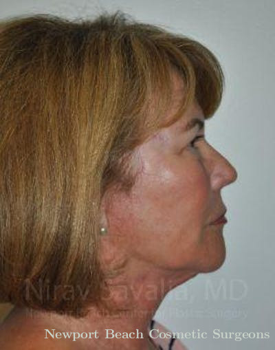 Facelift Before & After Gallery - Patient 1655694 - After