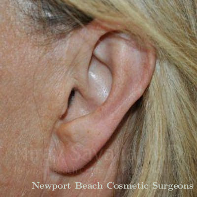 Torn Earlobe Repair Ear Gauge Repair Before & After Gallery - Patient 1655697 - After
