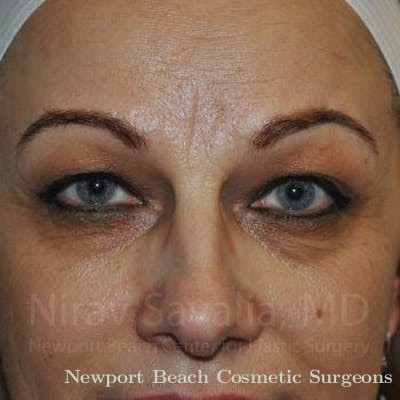 Liposuction Before & After Gallery - Patient 1655701 - Before