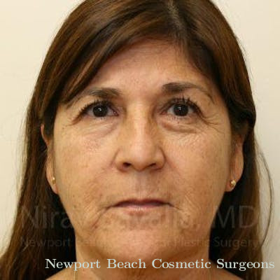 Fat Grafting to Face Before & After Gallery - Patient 1655702 - Before