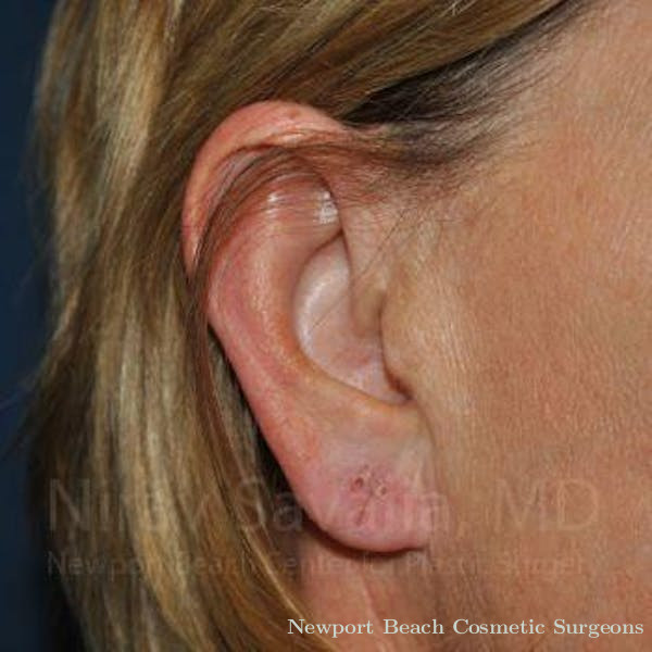 Torn Earlobe Repair Ear Gauge Repair Before & After Gallery - Patient 1655697 - Before