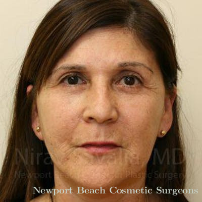 Breast Explantation En Bloc Capsulectomy Before & After Gallery - Patient 1655702 - After