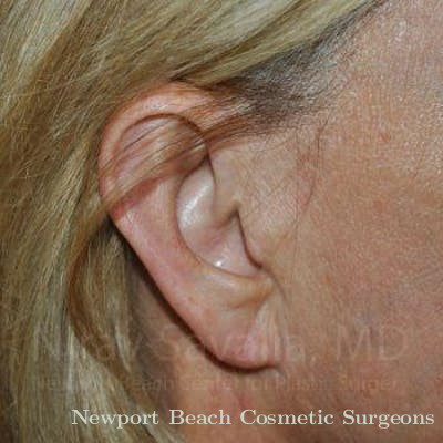 Torn Earlobe Repair Ear Gauge Repair Before & After Gallery - Patient 1655697 - After