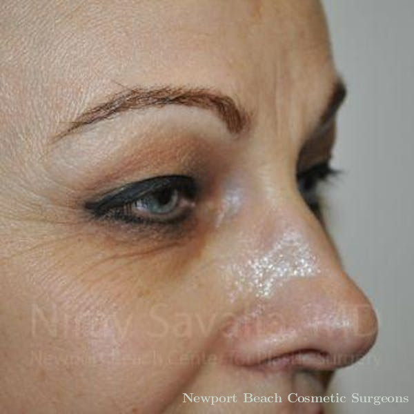 Facelift Before & After Gallery - Patient 1655701 - Before