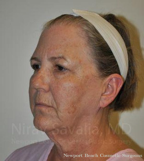 Fat Grafting to Face Before & After Gallery - Patient 1655699 - Before