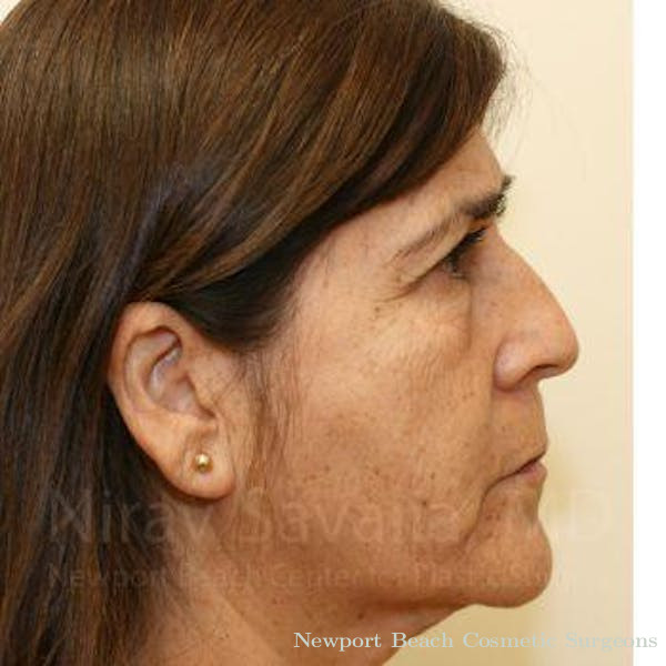 Fat Grafting to Face Before & After Gallery - Patient 1655702 - Before