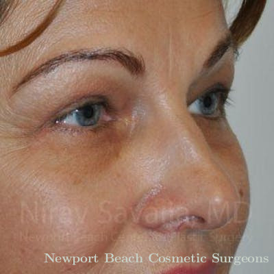 Facelift Before & After Gallery - Patient 1655701 - After