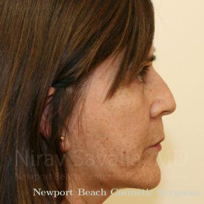 Facelift Before & After Gallery - Patient 1655702 - After