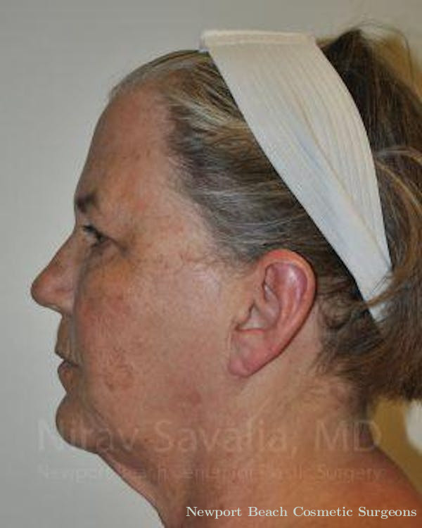 Facelift Before & After Gallery - Patient 1655699 - Before