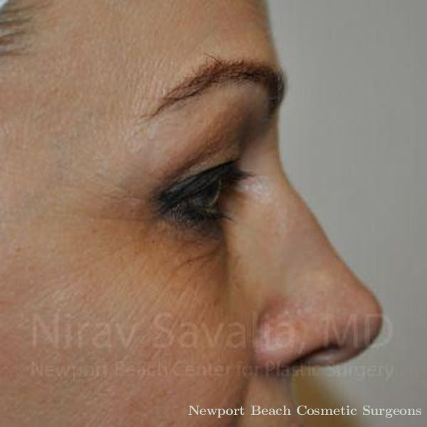 Mommy Makeover Before & After Gallery - Patient 1655701 - Before