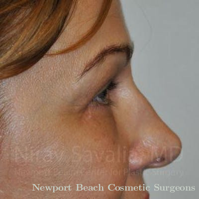 Liposuction Before & After Gallery - Patient 1655701 - After