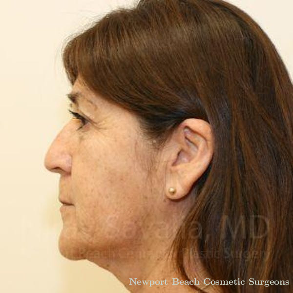 Facelift Before & After Gallery - Patient 1655702 - Before