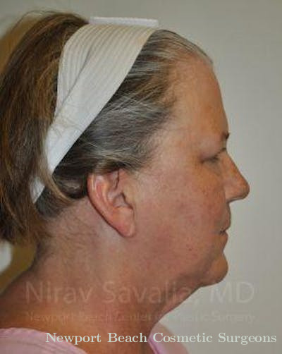 Torn Earlobe Repair Ear Gauge Repair Before & After Gallery - Patient 1655699 - Before