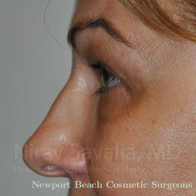 Fat Grafting to Face Before & After Gallery - Patient 1655701 - After