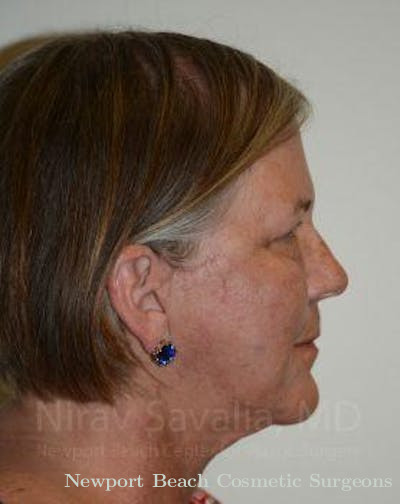 Torn Earlobe Repair Ear Gauge Repair Before & After Gallery - Patient 1655699 - After