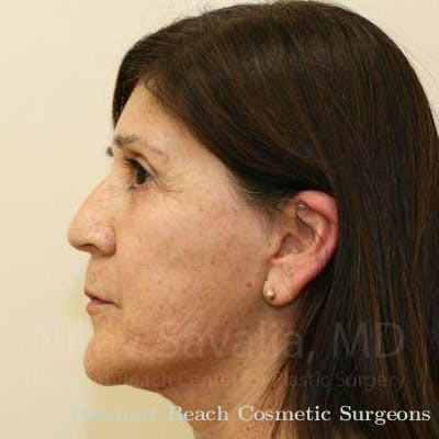 Liposuction Before & After Gallery - Patient 1655702 - After