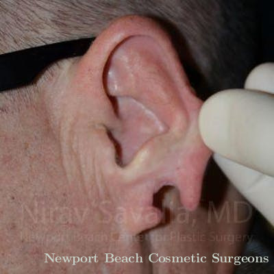 Torn Earlobe Repair Ear Gauge Repair Before & After Gallery - Patient 1655700 - Before