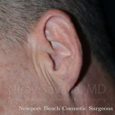 Torn Earlobe Repair Ear Gauge Repair Before & After Gallery - Patient 1655700 - After