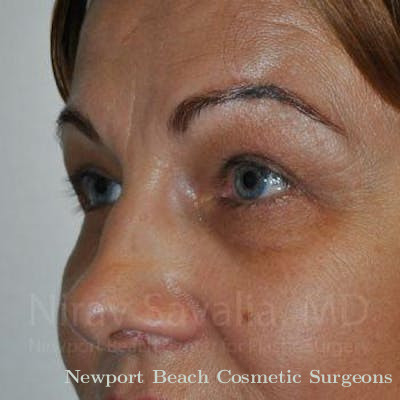 Mommy Makeover Before & After Gallery - Patient 1655701 - After