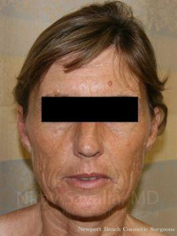 Oncoplastic Reconstruction Before & After Gallery - Patient 1655704 - Before