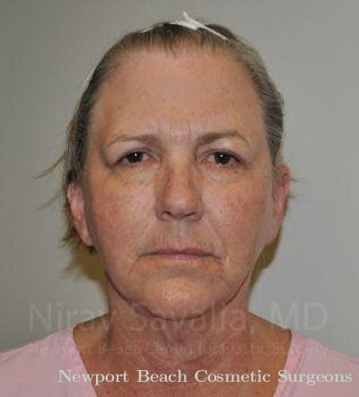Facelift Before & After Gallery - Patient 1655705 - Before