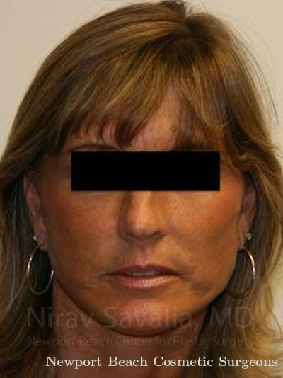 Brow Lift Before & After Gallery - Patient 1655704 - After