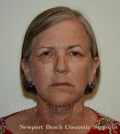 Facelift Before & After Gallery - Patient 1655705 - After
