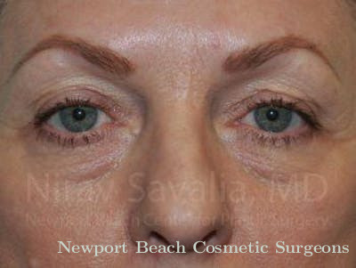 Brow Lift Before & After Gallery - Patient 1655707 - Before