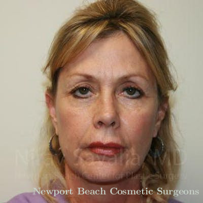 Facelift Before & After Gallery - Patient 1655706 - Before