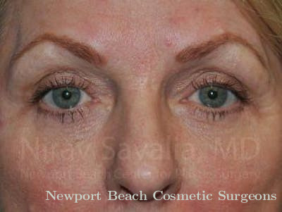 Eyelid Surgery Before & After Gallery - Patient 1655707 - After