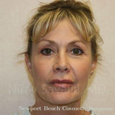 Mastectomy Reconstruction Revision Before & After Gallery - Patient 1655706 - After