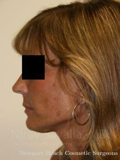 Eyelid Surgery Before & After Gallery - Patient 1655704 - After