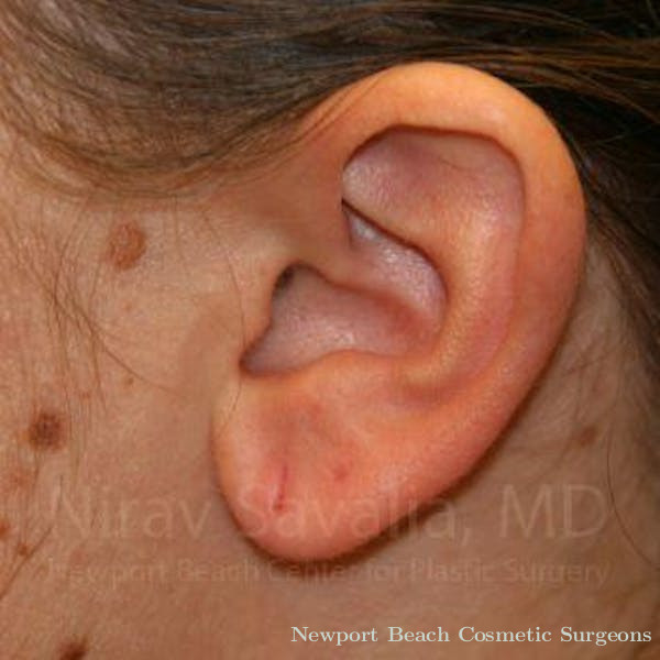 Torn Earlobe Repair Ear Gauge Repair Before & After Gallery - Patient 1655703 - Before