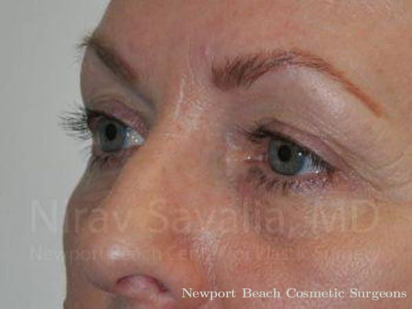 Eyelid Surgery Before & After Gallery - Patient 1655707 - Before